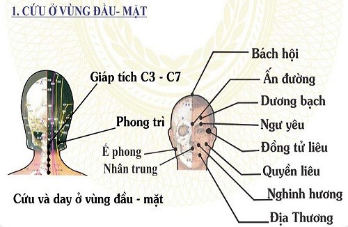 Điều trị những di chứng sau tai biến mạch máu não bằng đông y. (05/4/2016)