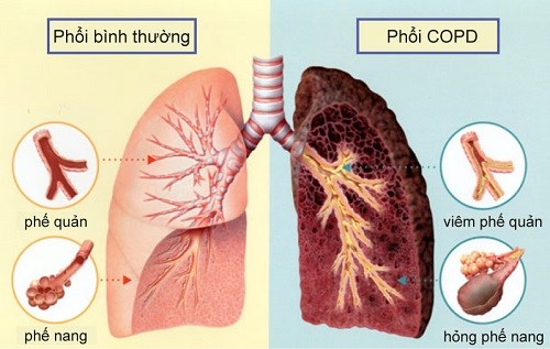 Bệnh phổi tắc nghẽn mạn tính và những điều cần biết (23/12/2018)