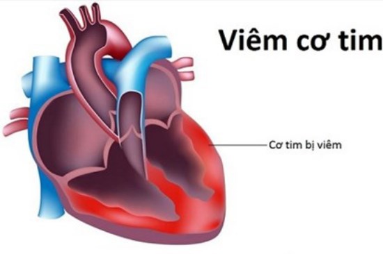 THỜI SỰ 18H CHIỀU 29/10/2019: Cục Y tế dự phòng khẳng định thông tin về loại vi rút gây viêm cơ tim dẫn đến tử vong là không chính xác.