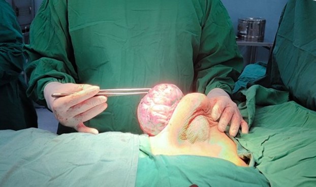Phẫu thuật loại bỏ thành công khối u sợi tuyến vú khổng lồ kích thước 15cm trên một nữ bệnh nhi 15 tuổi (09/11/2022) 