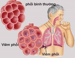 Chủ động phòng tránh bệnh viêm phổi như thế nào? (25/2/2023)