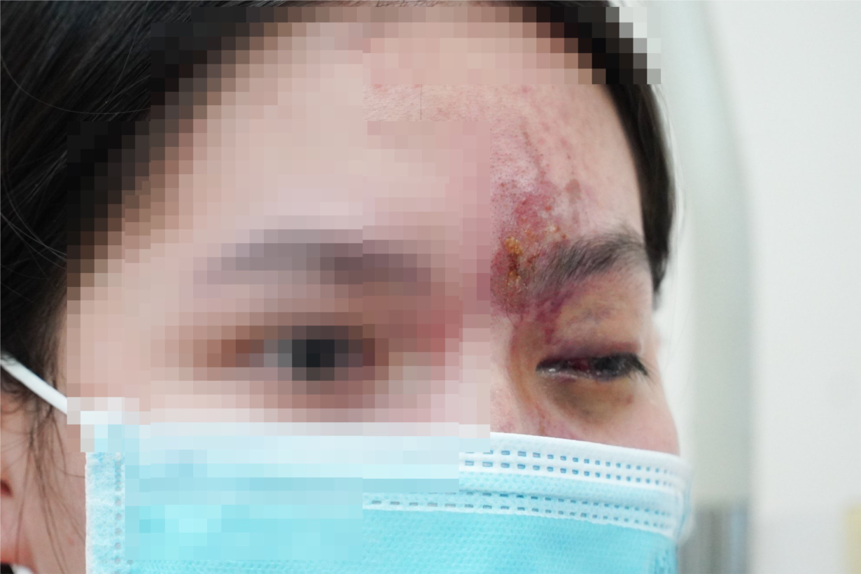Hiểm họa làm đẹp cấp tốc để đi chơi Tết (21/1/2024)
